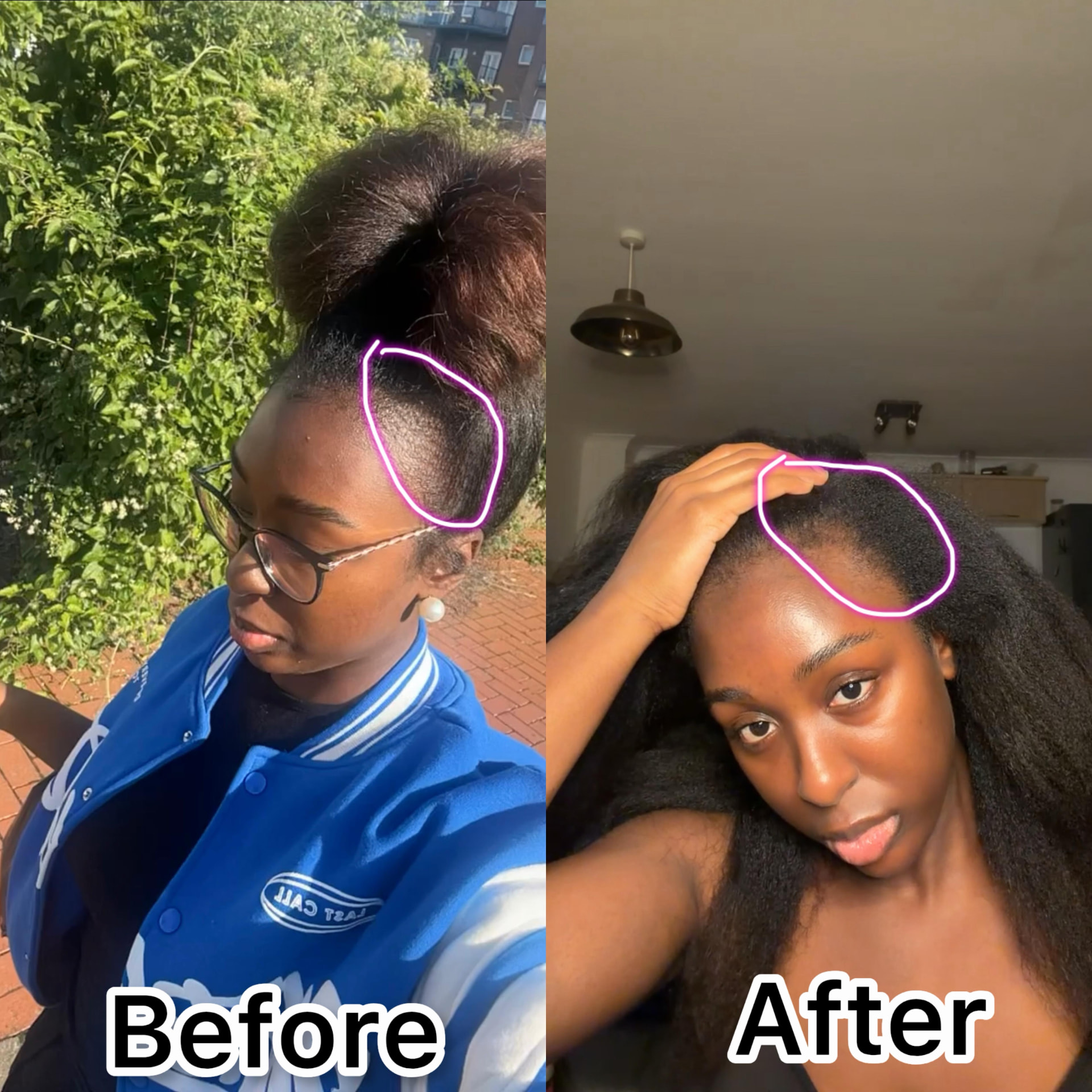 Before and after showing healthier edges with ROYALAE hair oil